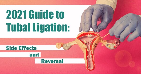 2021 Guide to Tubal Ligation: Side Effects and Reversal