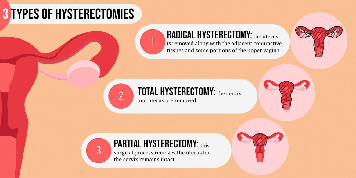 Hysterectomy Side Effects