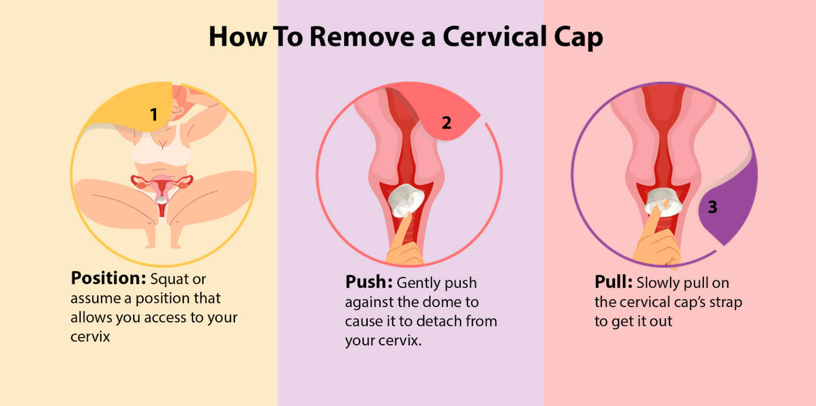 cervical cap